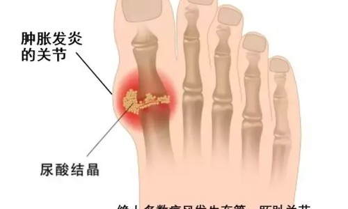 痛风病人能喝豆浆吗-痛风病人能喝柠檬水吗专区_痛风病人能喝茶吗专区_痛风病人能喝松茸酒吗网